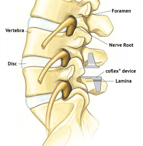 Coflex - NeurotexasNeurotexas